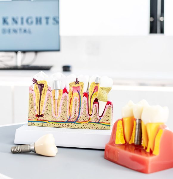 Merthyr Tydfil dental implants